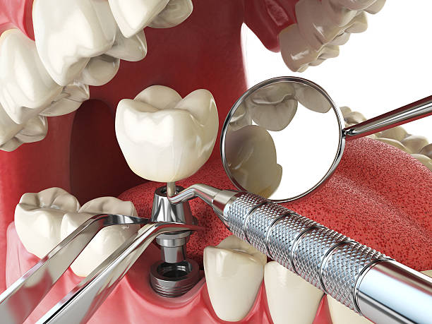 Best Emergency Dental Care for Sports Injuries in Quincy, IL